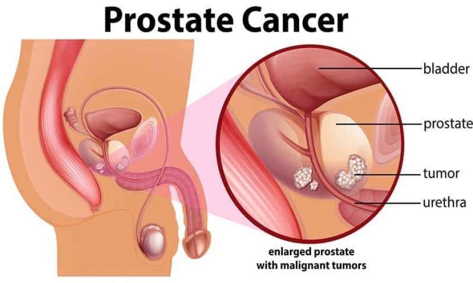 تأثير علاج ورم البروستاتا على الصحة النفسية