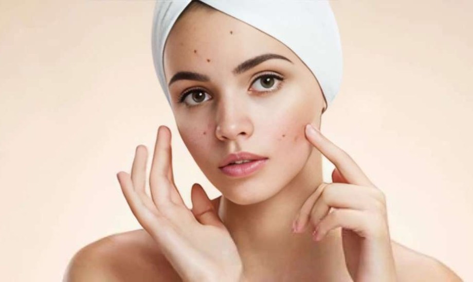 كيف تتعامل مع حب الشباب في فصل الصيف؟