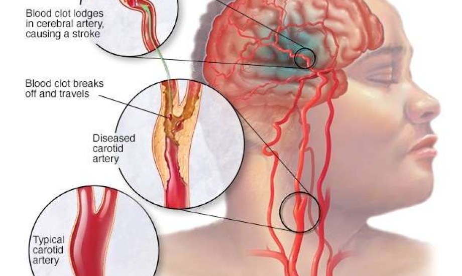 %20 من السكتات الدماغية تحدث خلال النوم