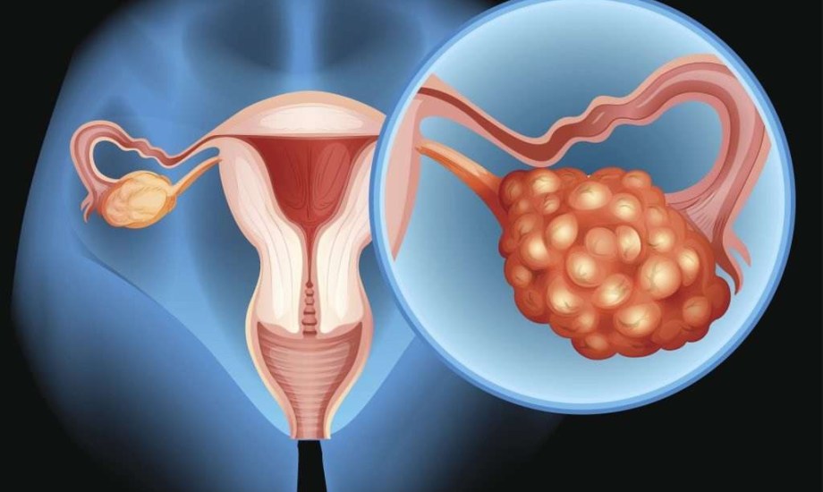 دواء relacorilant.. هل يصبح المنقذ لمرضى أورام المبيض؟