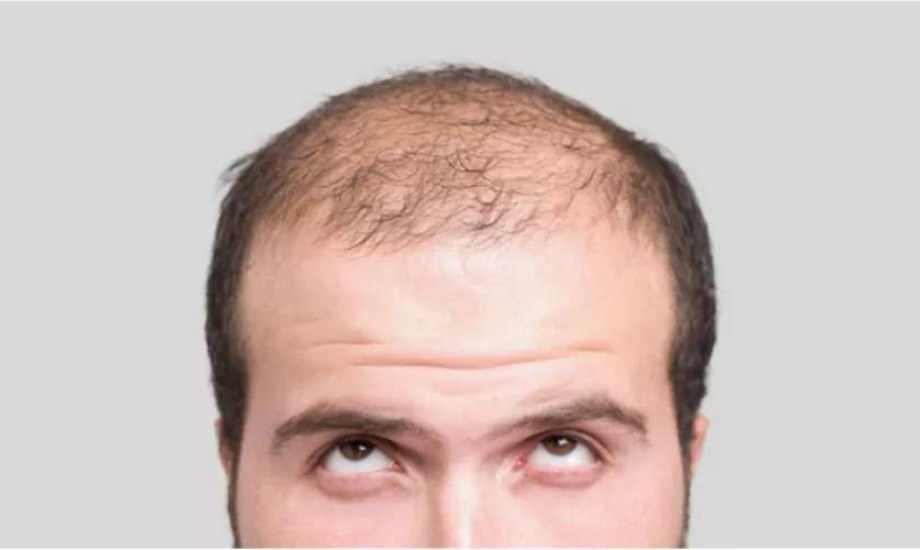 الرجال قصيرو القامة أكثر عرضة للإصابة بالصلع