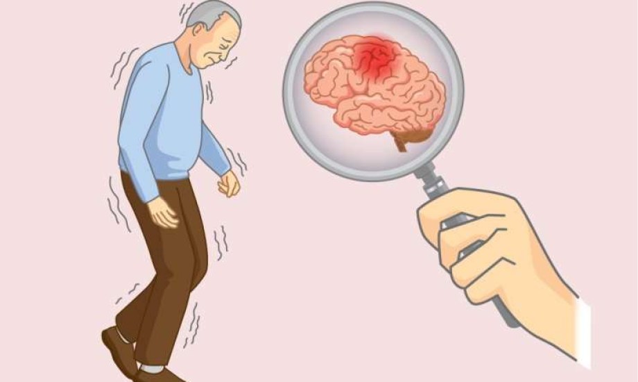 شيخوخة الدماغ تزيد خطر الزهايمر والوفاة المبكرة