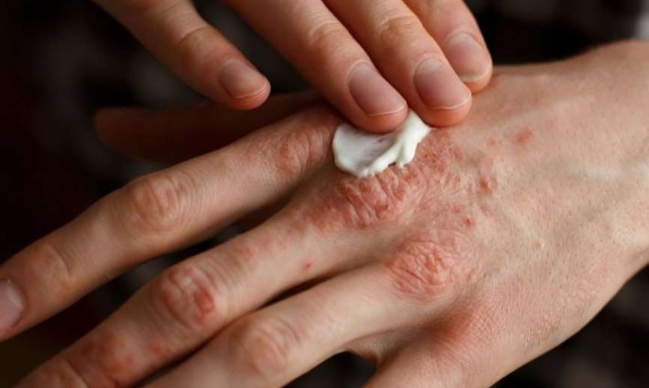 دواء Anzupgo.. أول علاج موضعي غير ستيرويدي للإكزيما المزمنة في اليدين