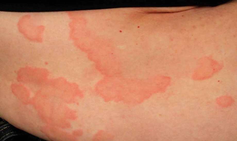 بين الحقن والأقراص.. خيارات علاجية واعدة لمرضى الشري المزمن