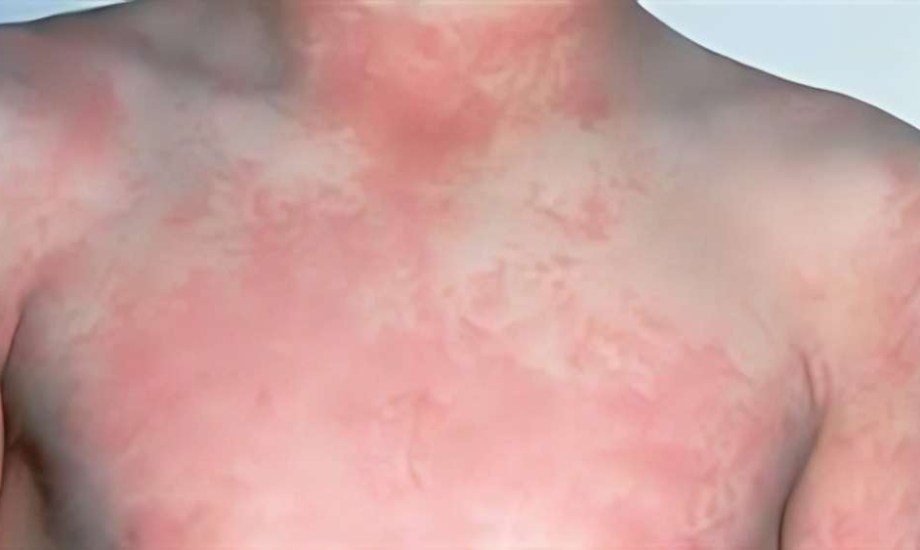 الطفح الوردي.. عدوى فيروسية شائعة تصيب الصغار وتقلق الآباء 