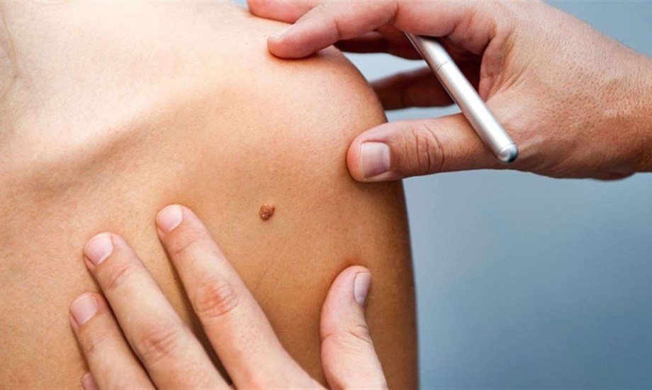 طفرة في علاج أورام الجلد: العلاج المناعي قبل وبعد الجراحة يظهر نتائج مبهرة