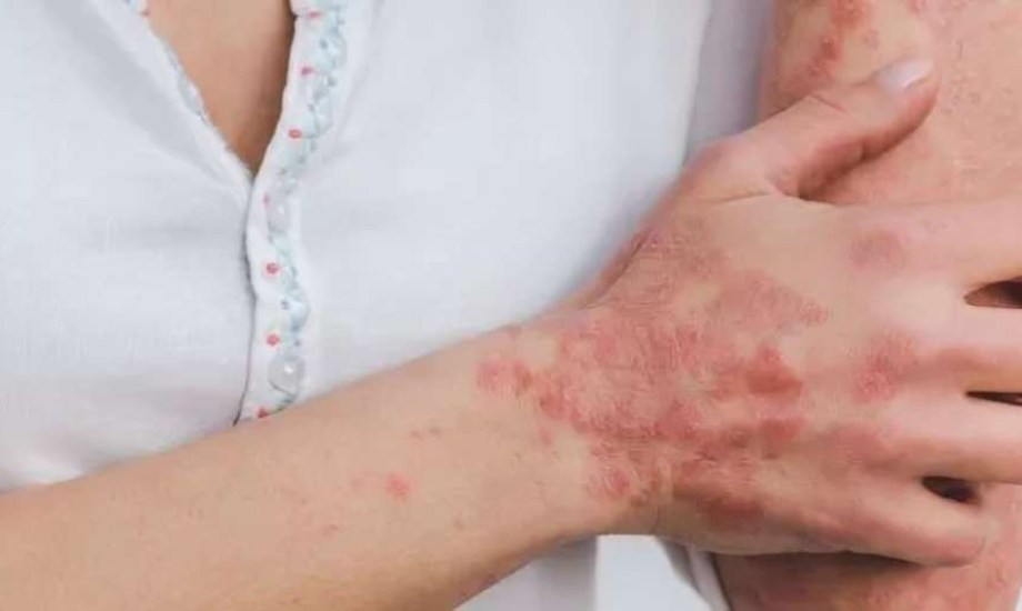 علاج فموي بسيط للصدفية الشديدة على الأبواب