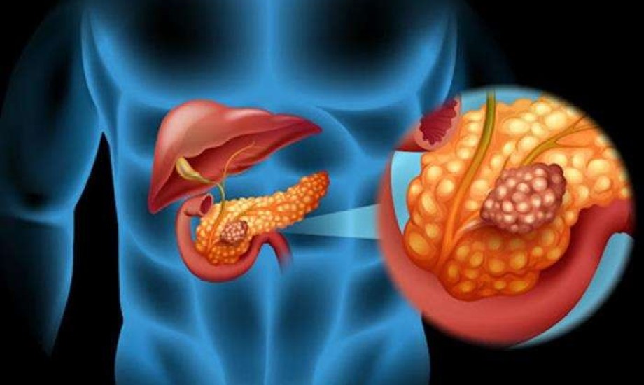 دواء جديد لأورام البنكرياس يحصل على تصنيف المسار السريع من الـFDA