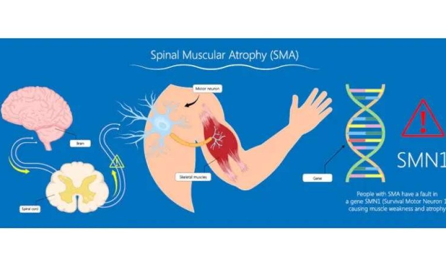دواء واعد لضمور العضلات يحصل على تصنيف علاج ثوري من FDA