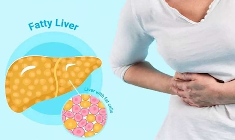 5 عوامل تجعل النساء أكثر عرضة للكبد الدهني مقارنة بالرجال