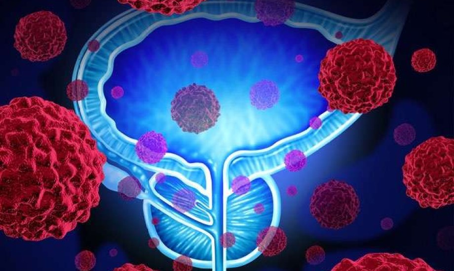 %30 من أورام البروستاتا المصنفة آمنة قد تكون عدوانية