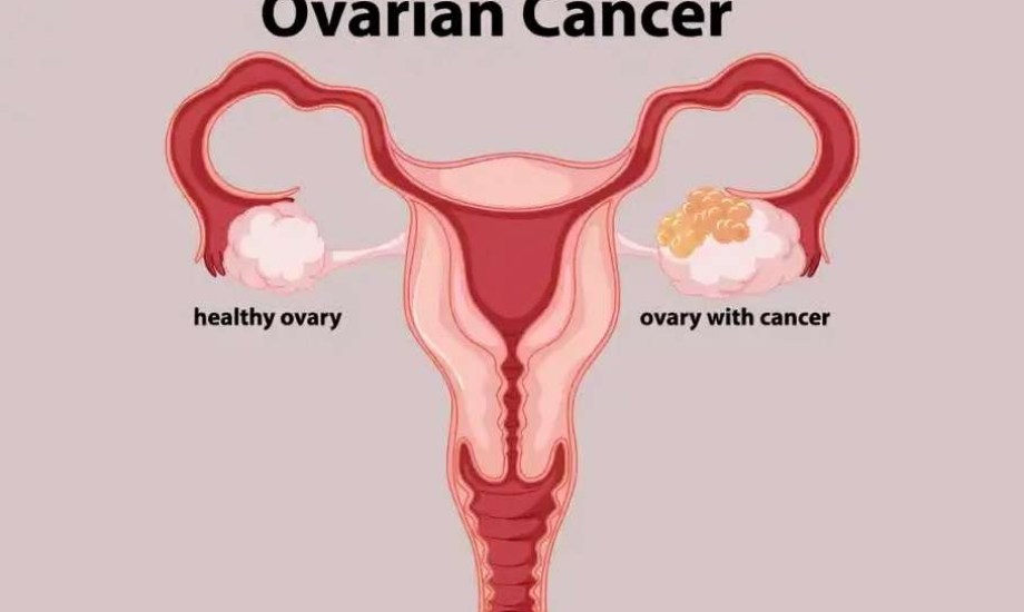 كيف تتعرفين على الأعراض المبكرة لأورام المبيض؟