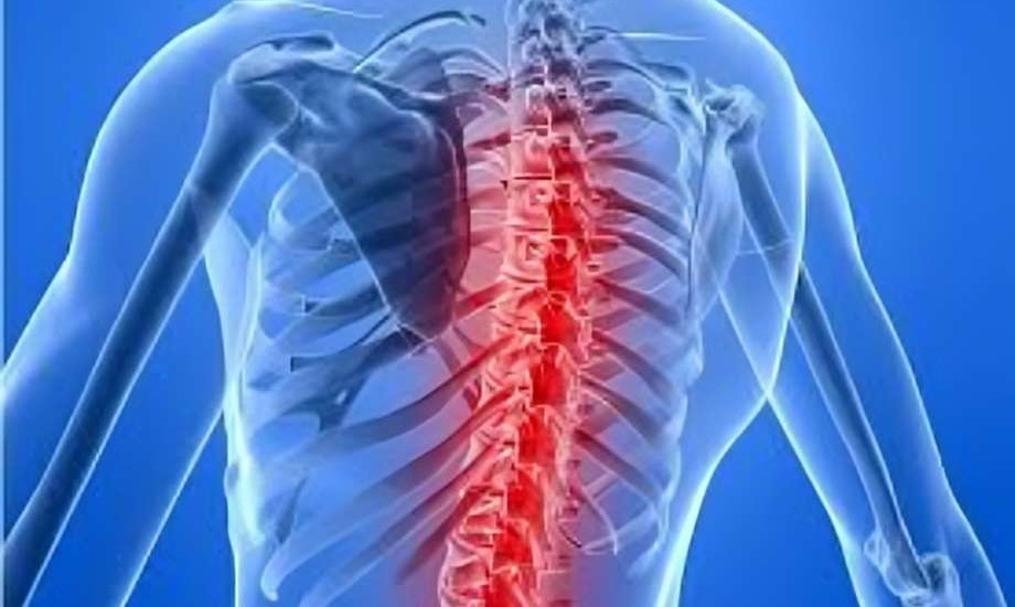  مرض ضمور العضلات الشوكي