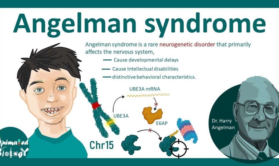 هل يعيش طفل متلازمة أنجلمان حياة طبيعية؟