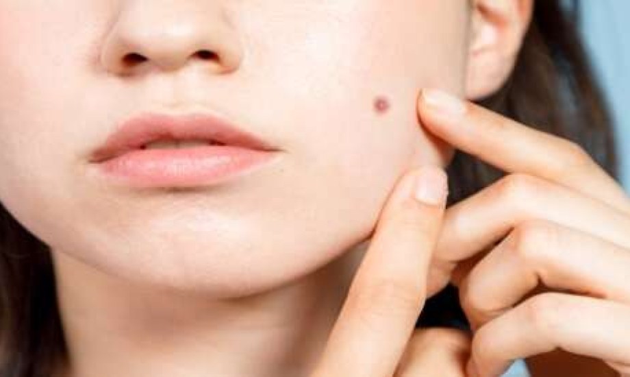 لماذا تظهر الشامات الجلدية بكثرة عند مرضى السكري؟