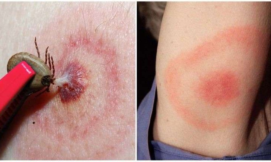 كيف يؤثر مرض لايم على الجهاز العصبي؟