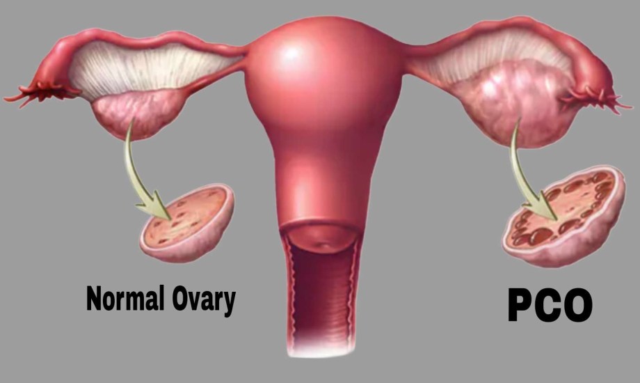 كيف يمكن التعايش مع تكيس المبايض؟