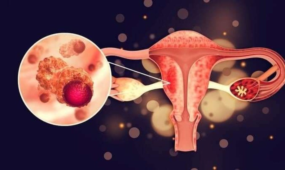 الذكاء الاصطناعي يظهر كفاءة عالية في تشخيص أورام المبيض