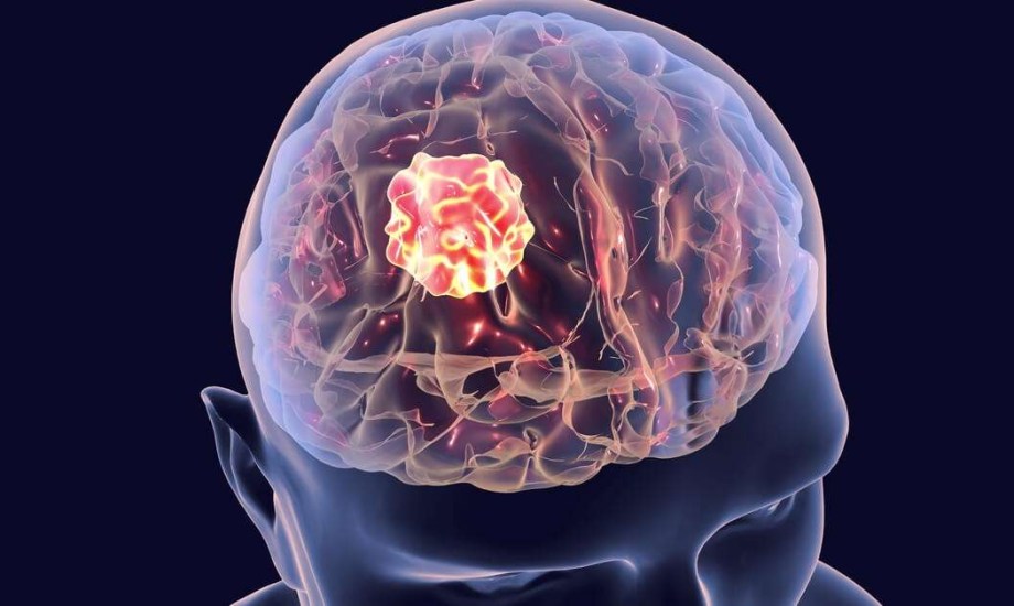 دليل شامل للتغيرات السلوكية لمرضى أورام المخ