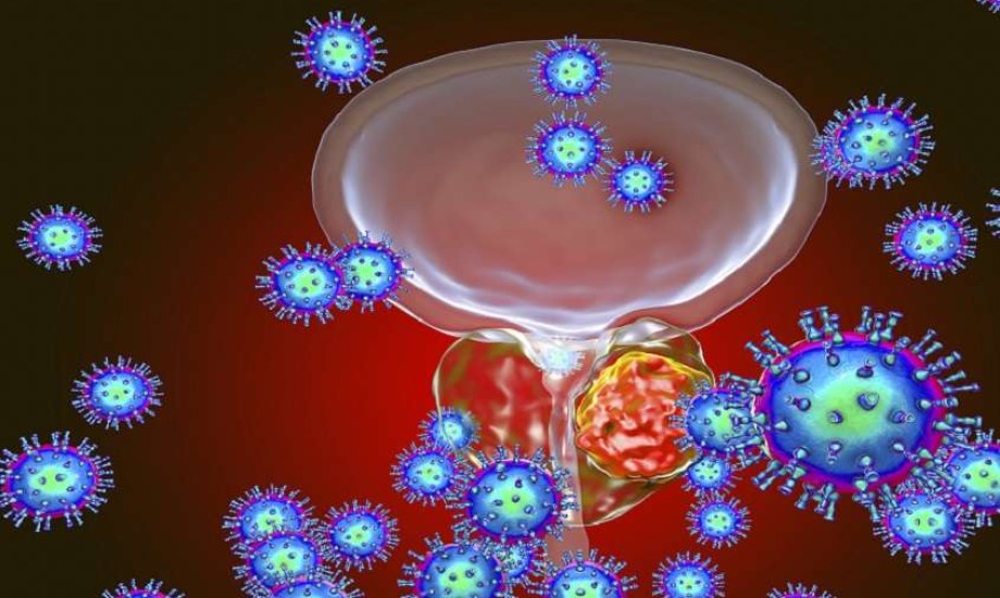 تقنية جديدة لتشخيص أورام البروستاتا توفر الوقت والتكلفة