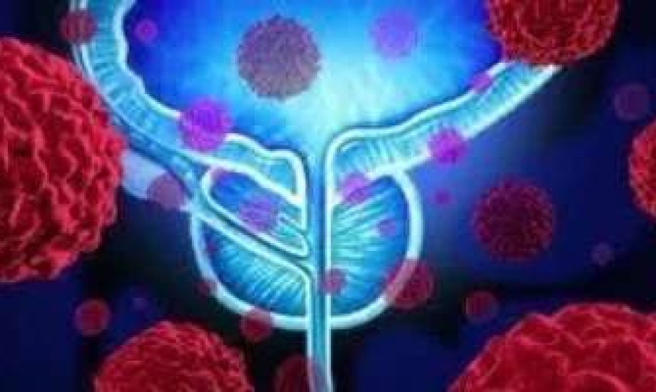 أورام البروستاتا بعد السبعين