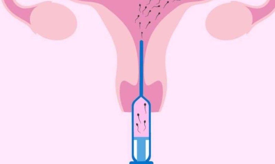 6 حالات طبية تستدعي اللجوء إلى التلقيح الصناعي