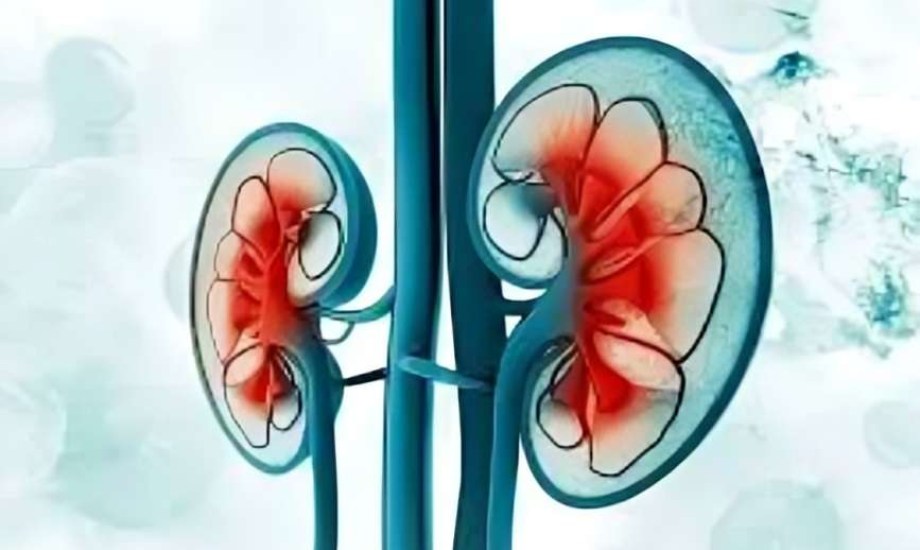 متلازمة الأيض الشديدة تزيد خطر الإصابة بأمراض الكلى المزمنة