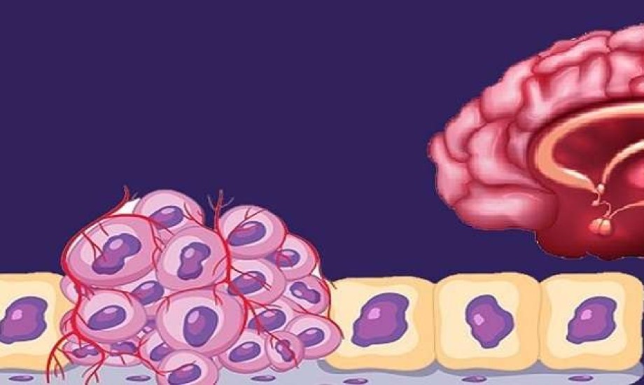 ارتفاع معدلات الشفاء من أورام الجهاز العصبي لدى الأطفال في أوروبا