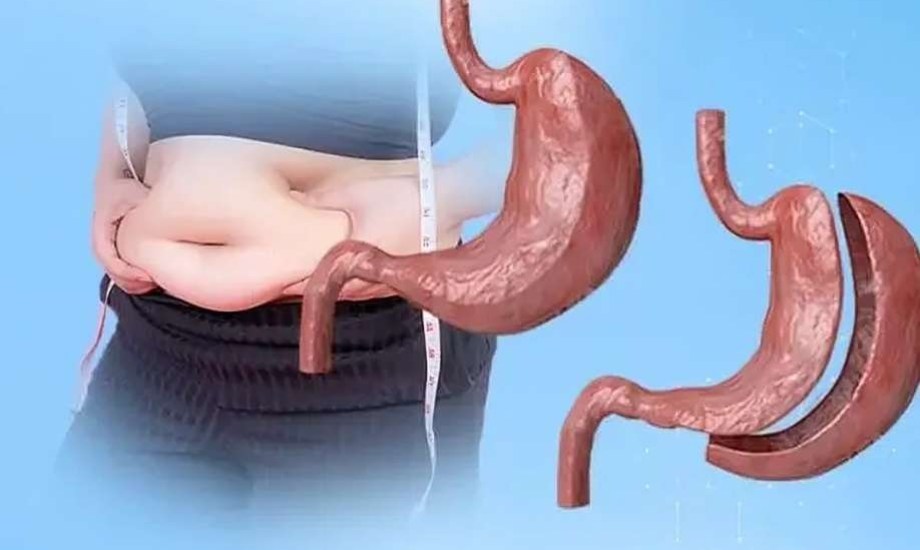 دراسة جديدة تنفي فائدة سيماجلوتايد التمهيدية قبل جراحات السمنة