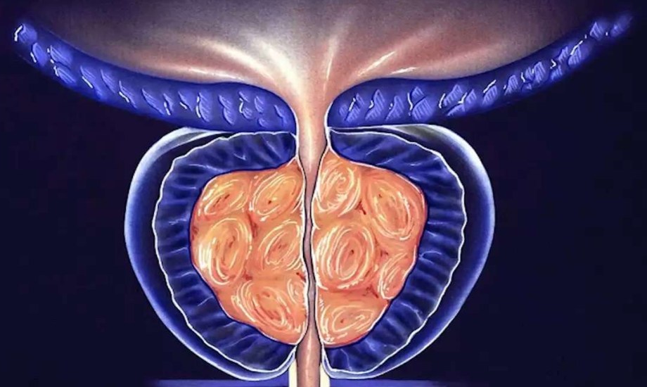 هل نبات السيرينوا يعالج تضخم البروستاتا؟