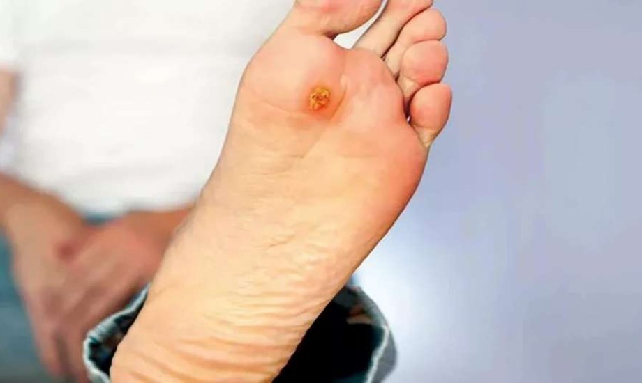 كيف يمكن علاج قرح القدم السكري؟