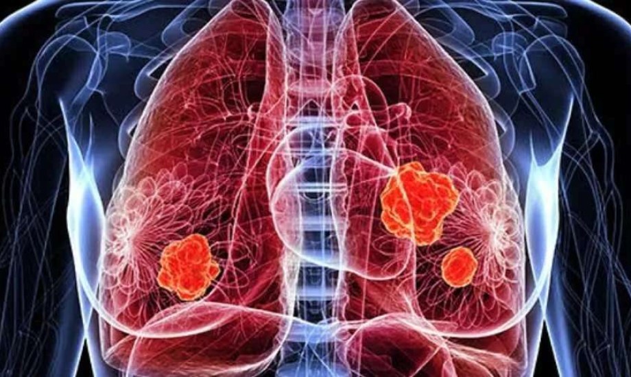 أول دواء يعالج السبب الجذري لأورام الجهاز التنفسي الحليمية المتكررة