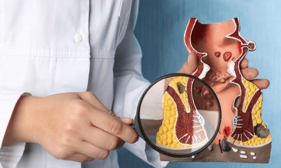 7 أطعمة ومشروبات محظورة لمرضى البواسير