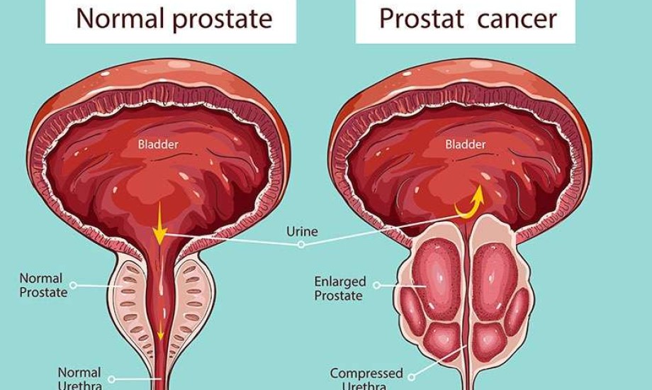 كيف تقلل الأطعمة الصحية من نمو أورام البروستاتا؟