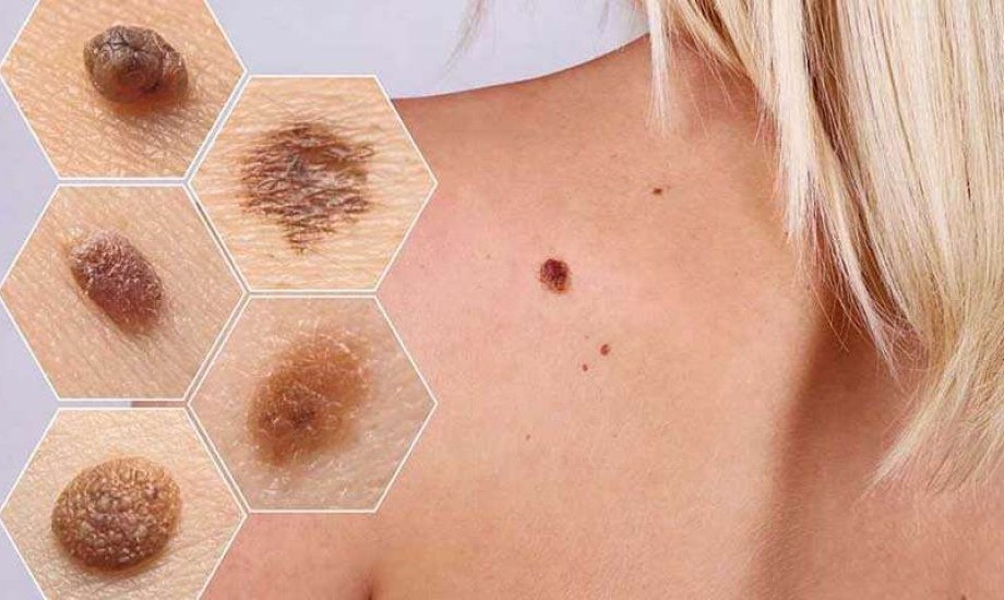 لاصقة ذكية جديدة تكشف أورام الجلد في المنزل