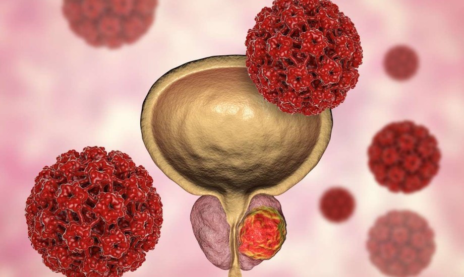 %50 من مرضى أورام البروستاتا يفضلون المراقبة النشطة عن العلاج التقليدي