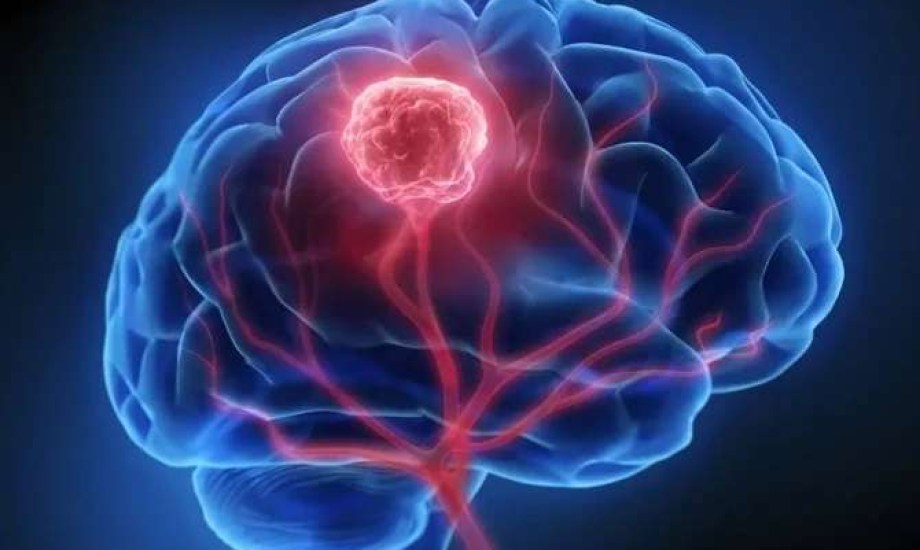 الإصابات الدماغية المتوسطة والشديدة تزيد خطر أورام المخ بنسبة 67%
