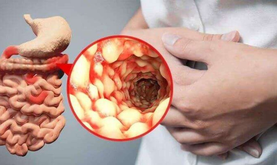 توصيات جديدة للحوامل المصابات بأمراض الأمعاء الالتهابية