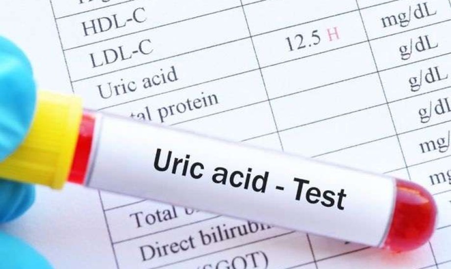 كيف يهدد ارتفاع حمض اليوريك صحتك؟