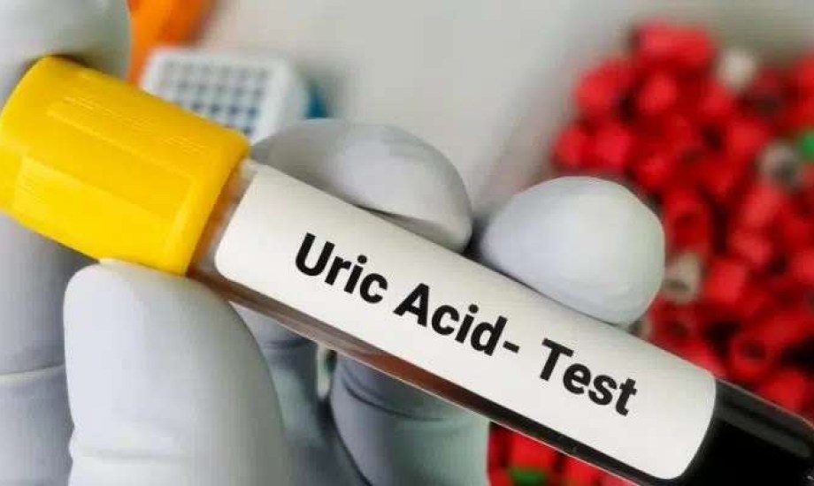 7 طرق طبيعية لخفض حمض اليوريك في الدم