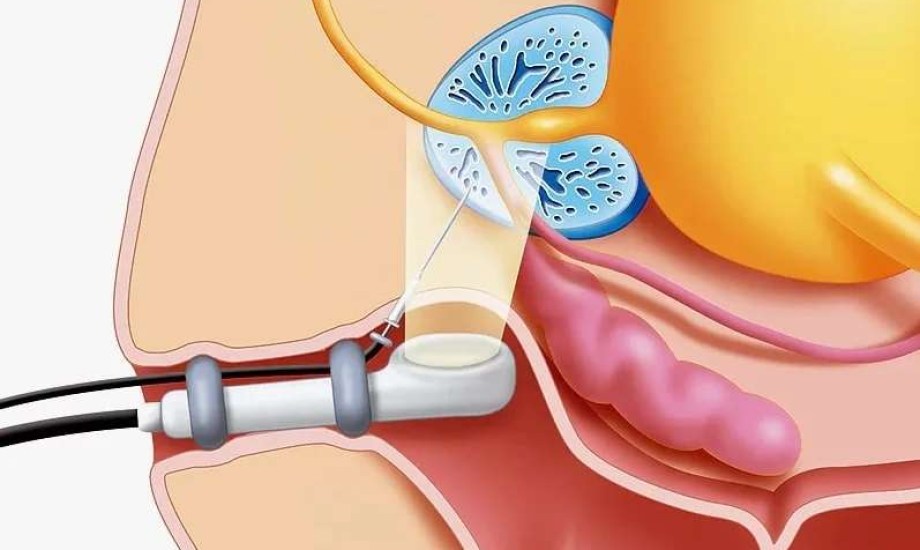ضعف الانتصاب بعد خزعة البروستاتا نادر ومؤقت