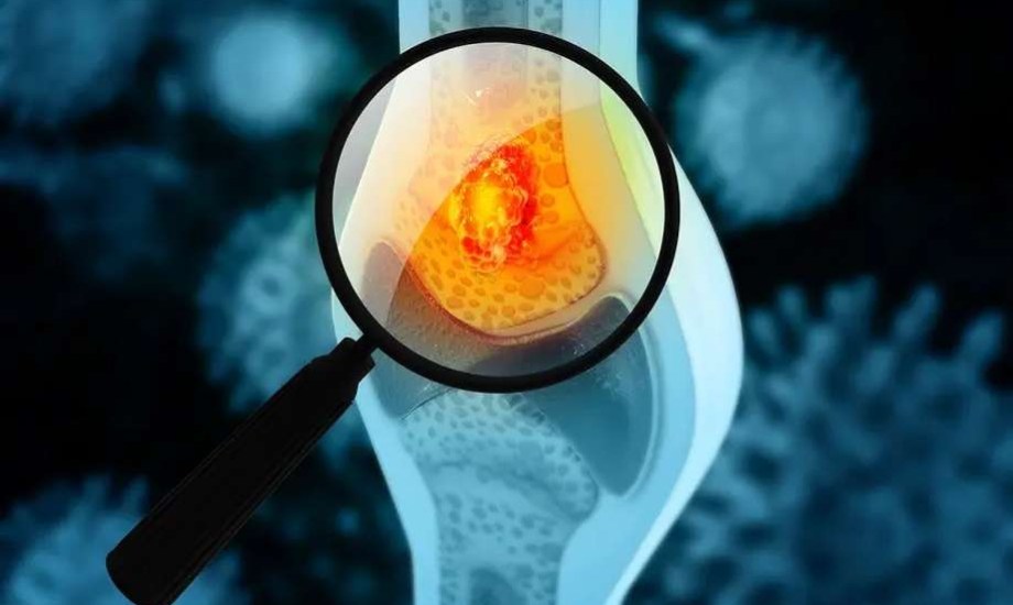 دواء جديد لعلاج مضاعفات العظام لدى مرضى الأورام