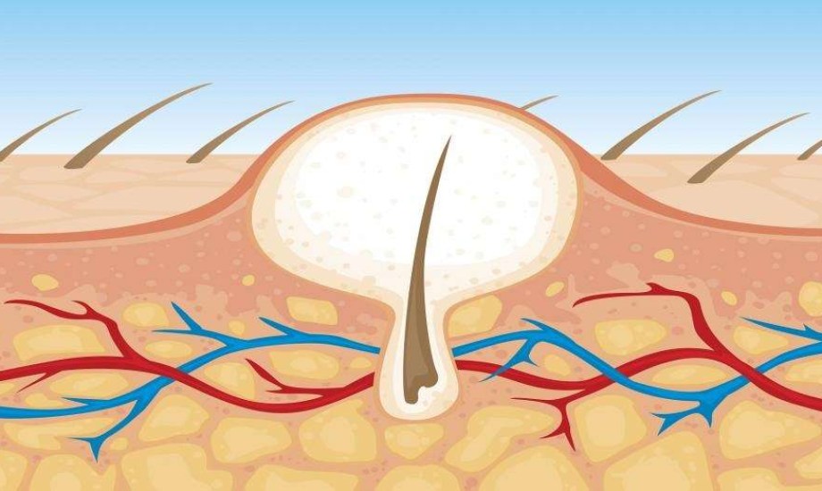 أفضل 3 طرق لعلاج الشعر الناشب في المنزل