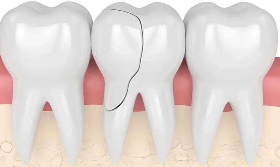 أسباب تشقق الأسنان