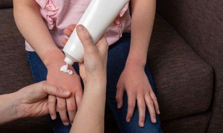 أول علاج موضعي للإكزيما عند الأطفال