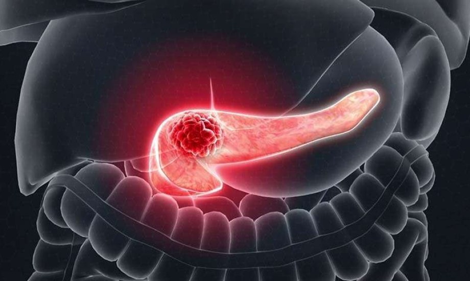 بكتيريا الفم تضاعف خطر الإصابة بأورام البنكرياس 3.5 مرات