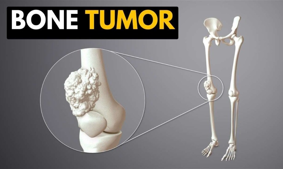 إدارة الدواء الأمريكية توافق على أول بديل بيولوجي لعلاج أورام العظام