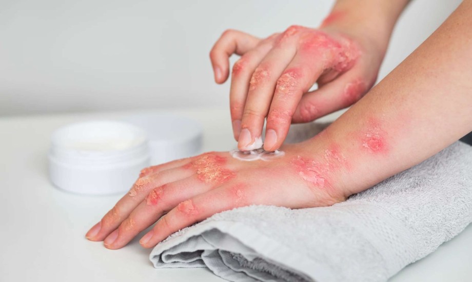 مرضى الصدفية أكثر عرضة للإصابة بالتنكس البقعي المرتبط بالعمر