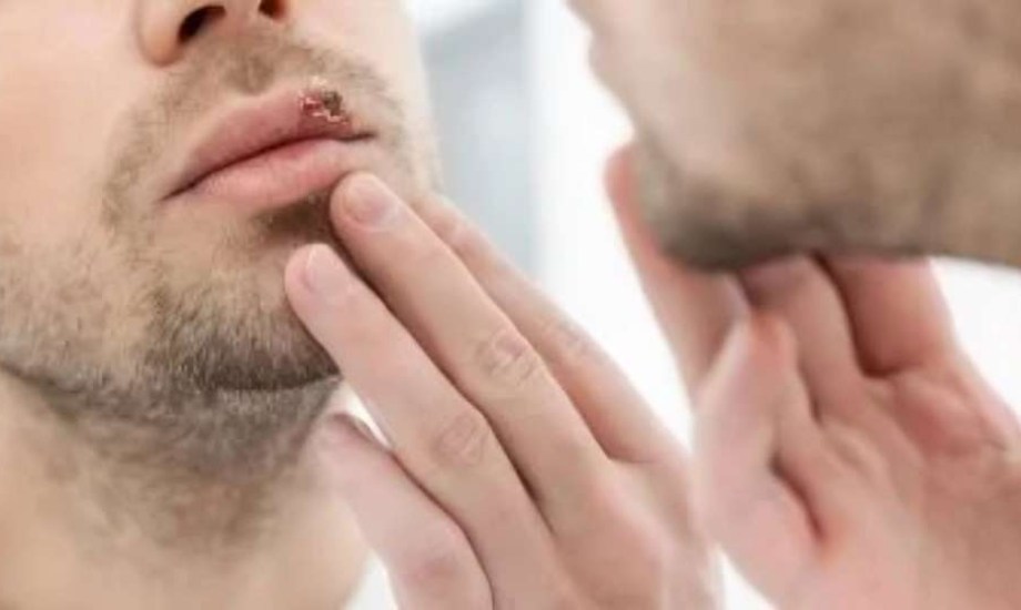 أول علاج فموي يومي يستهدف الأعصاب المصابة بالهربس مباشرة