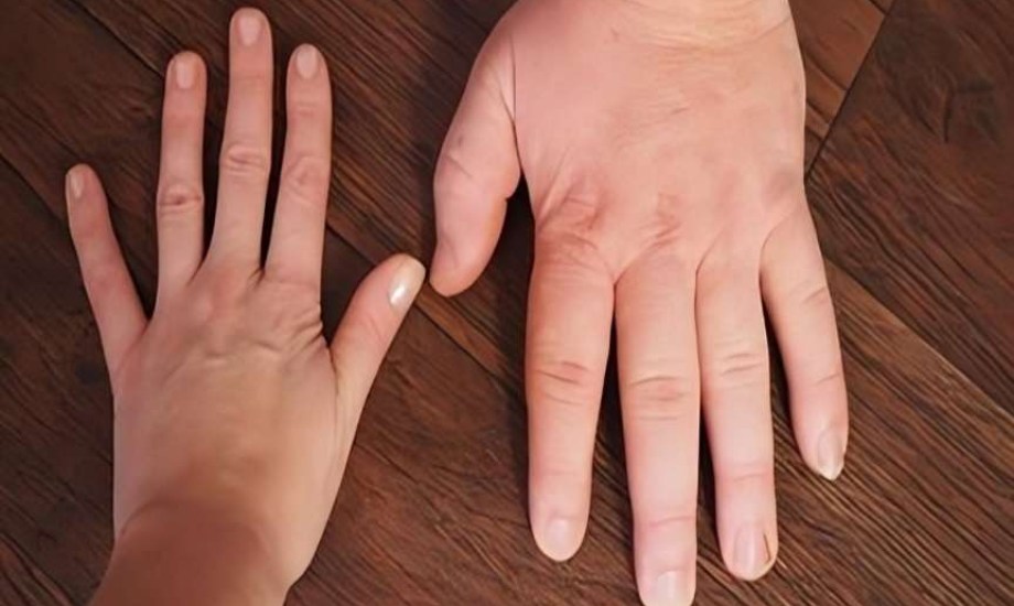 الموافقة على أول علاج فموي يومي لمرض تضخم الأطراف